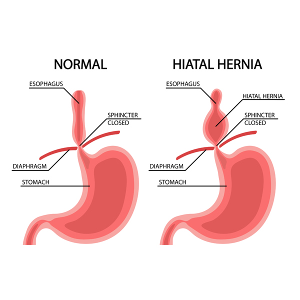 Hernia & Obesity Clinic - Zymus Hospital