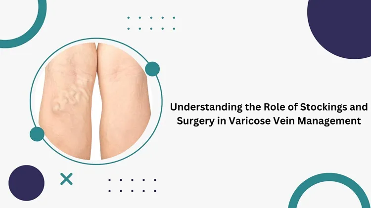 understanding the role of stockings and surgery in varicose vein management