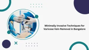 revolutionizing varicose vein treatment in bangalore the era of minimally invasive procedures